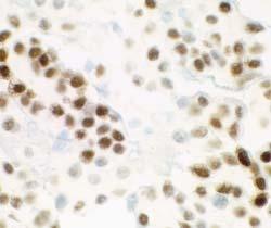 Anatomic Pathology / ORIGINAL ARTICLE A B C Image 1 Cell block sections from pleural fluids containing breast carcinoma.