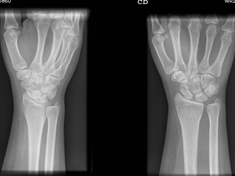 Boxer s Fracture Fracture of the 5