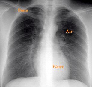 CXR: why get one? CXR is helpful in selected patients Dyspnea Cough Hemoptysis Fever Chest pain Thoracic trauma CXR: why get one?