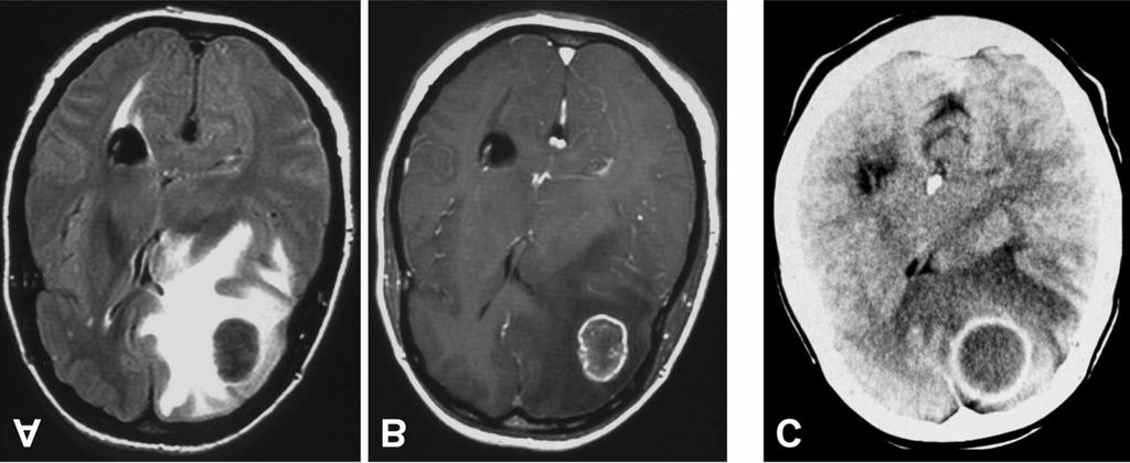 iii6 Figure 3. Differential diagnosis of a left frontal cystic lesion.