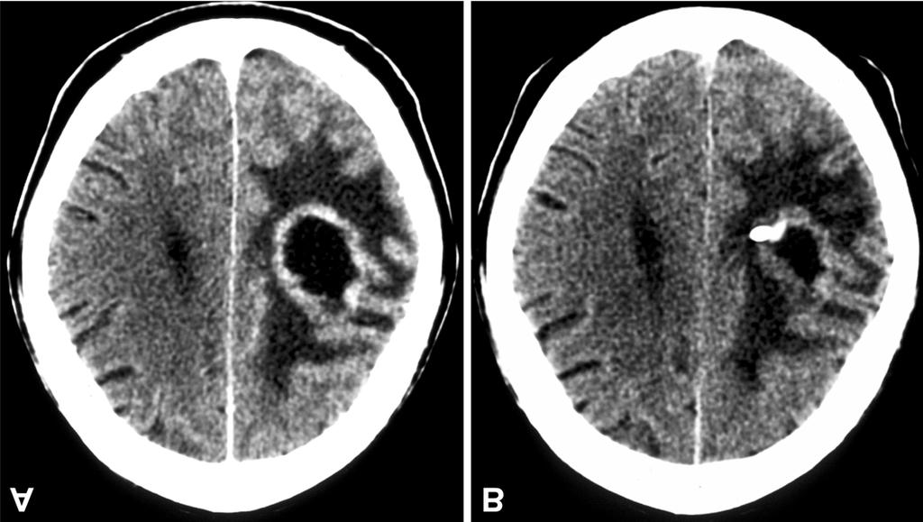 iii9 Figure 5. (A) Cystic metastasis of an adenocarcinoma left fronto-parietal. (B) Reduction of the lesion after drainage of the cyst and implantation of a Rickham reservoir.