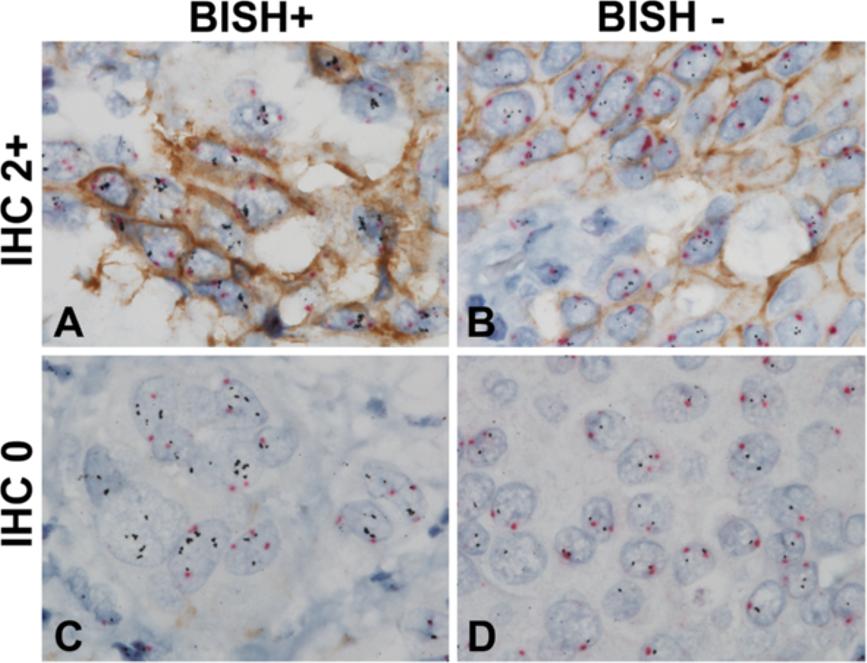 assay. The HER2 gene-protein assay carried out on FFPE breast cancer tissue microarray slides was able to differentiate HER2 IHC 2+ cases that were HER2 & CEN17 BISH positive (A) and negative (B).
