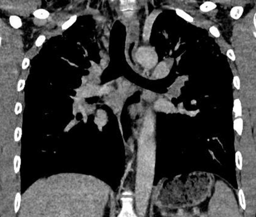 Fig. 4: HRCT scan, coronal reformation in mediastinal window, showing mediastinal and