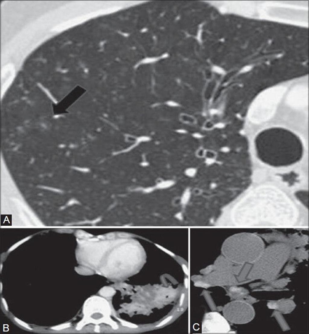 Fig. 5: Talcosis in a 63-year-old woman working in rubber industry. Axial HRCT images show small centrilobular nodules (black arrows, A) in upper lobes.