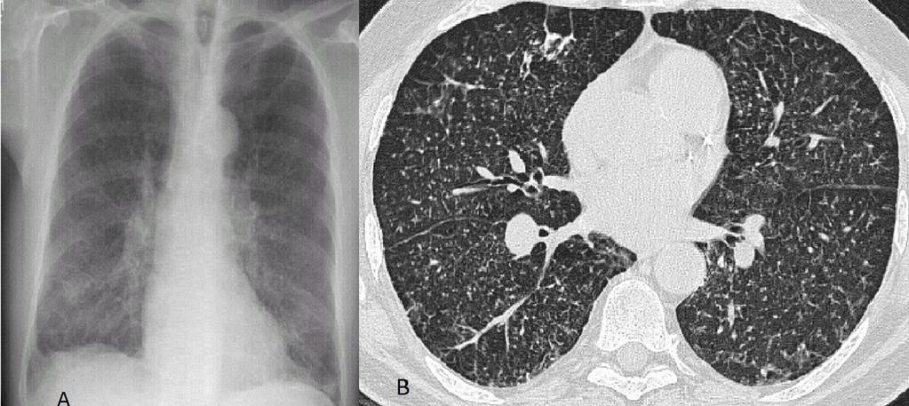 Fig. 6: Chest radiograph (A) demonstrating diffuse generalized reticular nodular shadowing and a chest CT scan (B) showing bilateral tiny nodular opacities throughout both lung fields predominantly