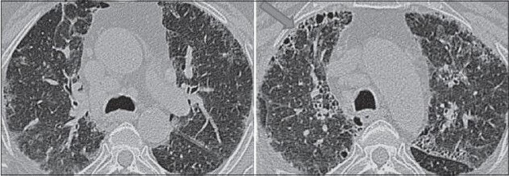 Journal of Medical Case Reports 2008; 2:257 Fig. 7: Siderosis with interstitial fibrosis in a lathe machine worker.