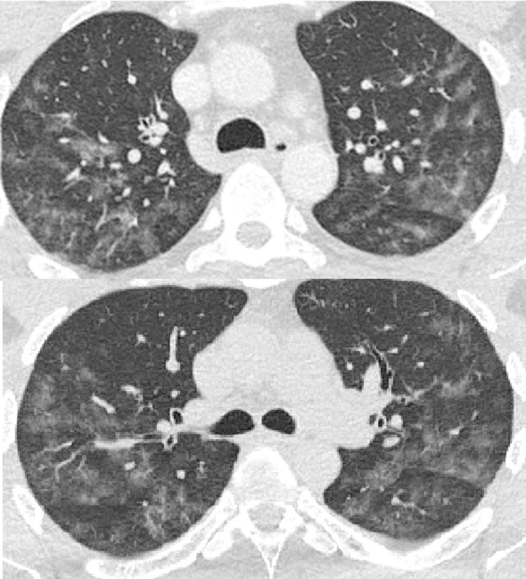 Fig. 8: Axial HRCT images showing bilateral patchy ground glass opacities, presumably due to pulmonary