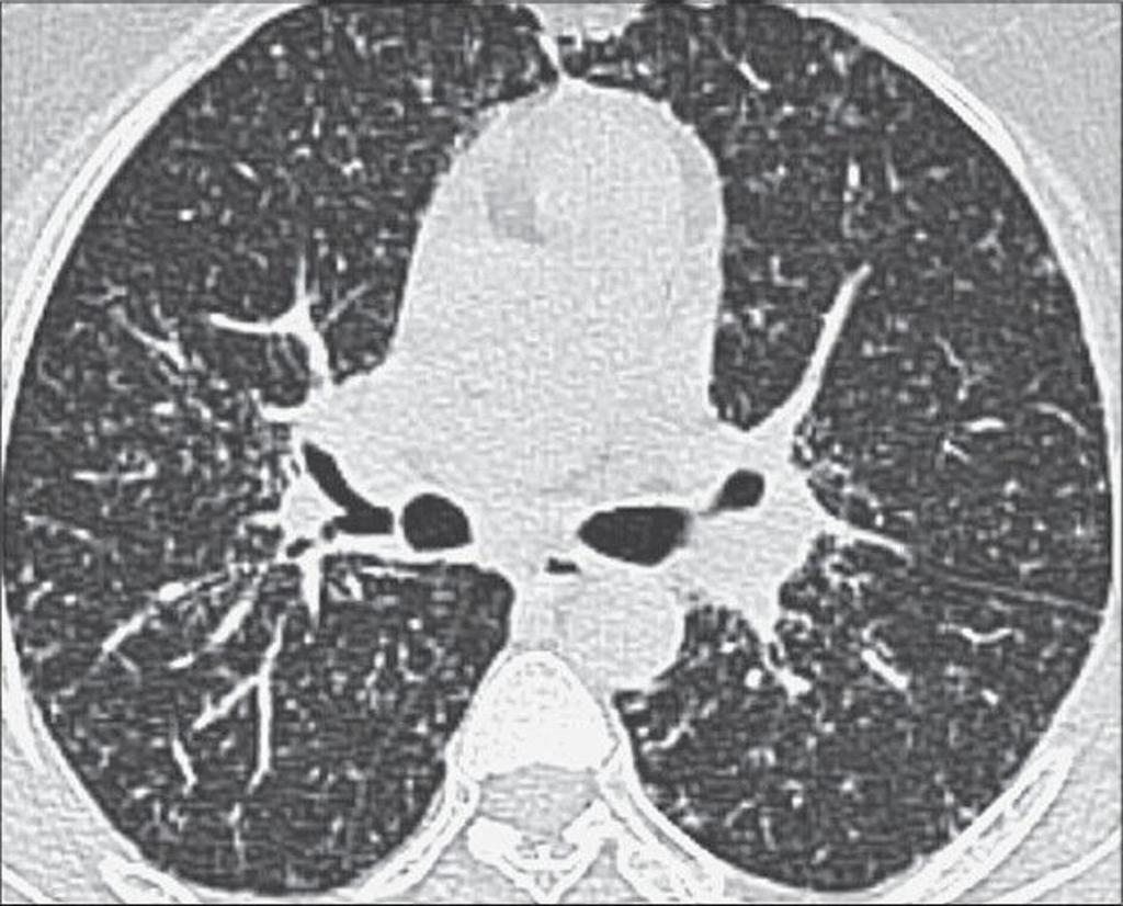 Fig. 2: A 38-year-old machinist with hard metal pneumoconiosis. Axial HRCT image shows numerous poorly defined centrilobular nodules in the upper lobes.
