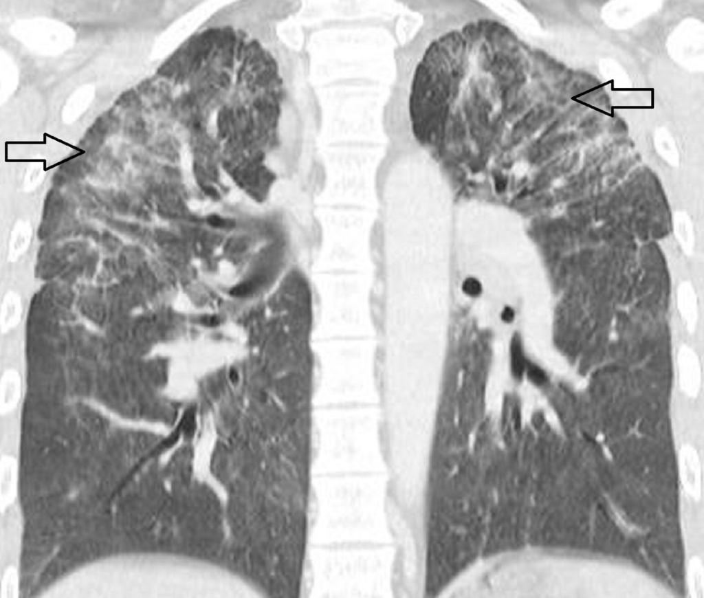 Fig. 3: HRCT scan, coronal reformation, showing bilateral multiple small centrilobular nodules, interlobular septal thickening and