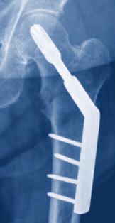 fractures, the DHS seems biomechanically superior to three cannulated screws.