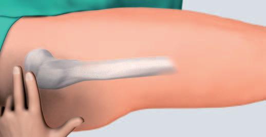 4 Access Make a straight lateral skin incision of 15 cm in length, starting two finger-widths proximal to the tip of the greater trochanter.