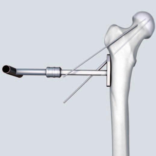In the case of unstable fractures, insert several Kirschner wires into the femoral head to temporarily stabilize the reduced fragments. 6 Insert guide wire Instruments 338.000 DHS/DCS Guide Wire 2.