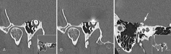 dehiscent canal via middle cranial fossa approach