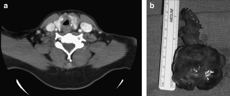 RARE TRACHEAL TUMORS 81 FIG. 1. (a) Axial computed tomography (CT) with contrast. Left thyroid mass neoplasm with circumferential tracheal mucosa thickening.