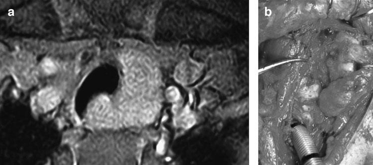 Cross-sectional imaging studies were performed on all patients, which revealed an intraluminal tracheal soft tissue mass adjacent to the thyroid gland.