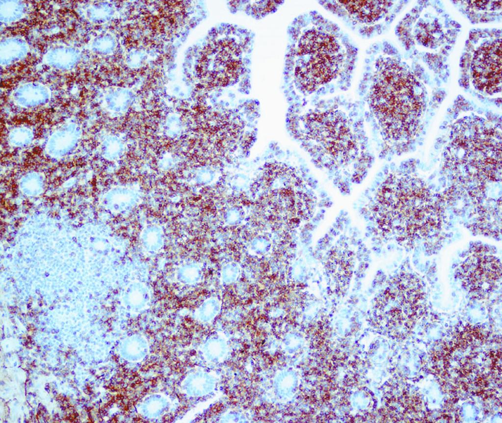 Case 98 was a case of refractory celiac disease in which the intraepithelial lymphocytes had an aberrant immunophenotype, raising the question about the boundary between refractory celiac disease and