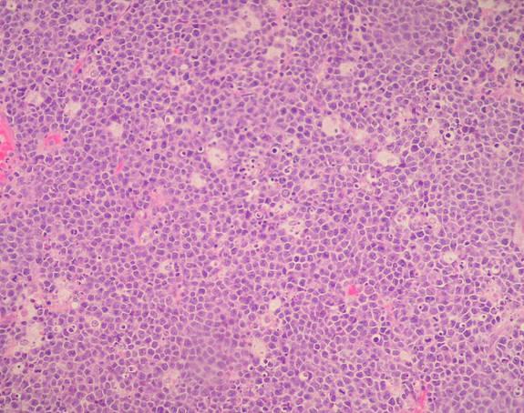 B-Cell Lymphoma, Unclassifiable, with