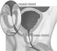 connection to heart disease The Prostate Gland The prostate is a heart-shaped gland located below the bladder It also surrounds the urethra The normal adult prostate weighs 15-20Gm