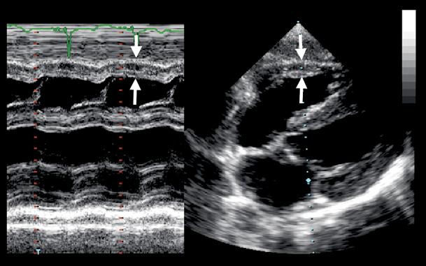Recommendations for chamber quantification 95 Figure 10 Methods of measuring right ventricular wall thickness (arrows) from an M-mode echo (left) and a subcostal transthoracic echo (right).