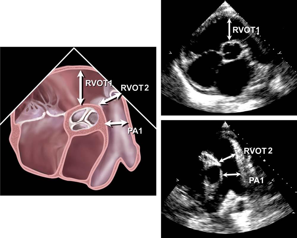 Recommendations for chamber quantification 97 Table 8 Reference limits and partition values of right ventricular size and function as measured in the apical four-chamber view 80 Reference range