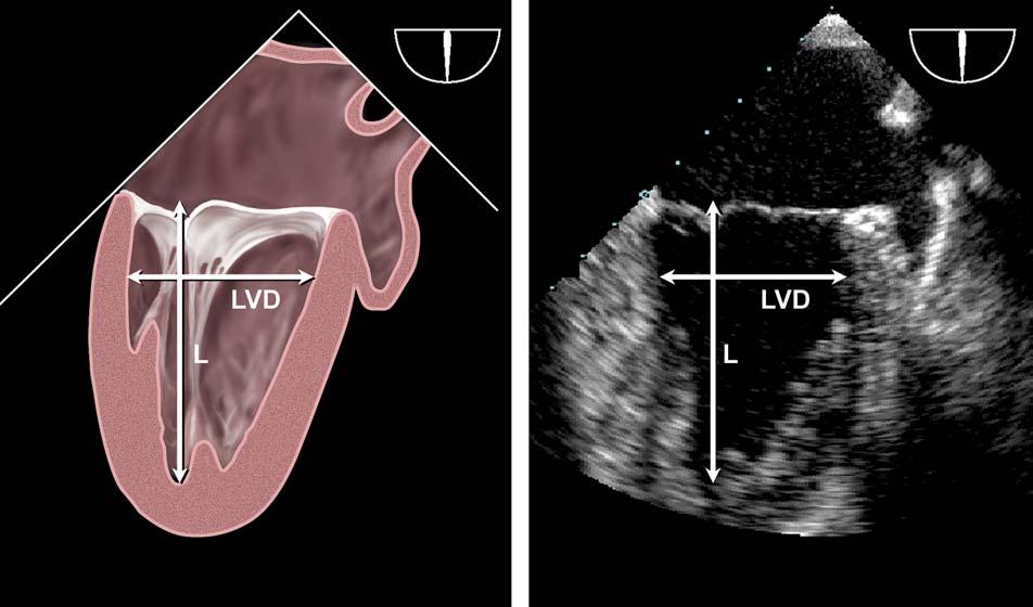 Recommendations for chamber quantification 85 Figure 2 Transesophageal measurements of left ventricular length (L) and minor diameter (LVD) from the midesophageal two-chamber view, usually best