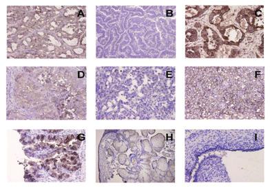 HE4 and CA125 for patients with ovarian cancer 129 Figure 3: Expression of HE4 in ovarian tumor tissues Immunohistochemical staining of HE4 in serous ovarian cancer (Fig3A, 400); mucous ovarian