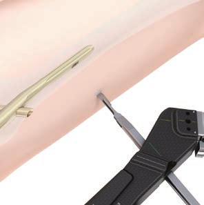 DISTAL LOCKING TFNA SHORT (170 mm, 200 mm and 235 mm) 1 Reconfirm reduction Instrument 03.010.