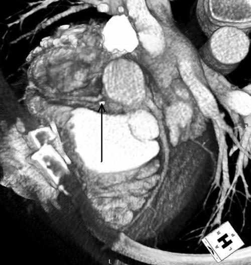 Anomalous RCA 70% LAD occlusion and LAD coated stent NA Angina after PCI NA anomalous RCA Anomalous RCA Normal except anomalous RCA RITA to RCA 7 mo Angina RITA occlusion Anomalous RCA Mild CAD and