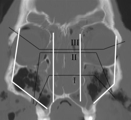 The Le Fort II pattern involves fractures through the zygomaticomaxillary and frontomaxillary sutures. The Le Fort III pattern involves complete craniofacial dissociation.