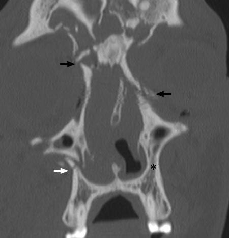 RG f Volume 26 Number 3 Hopper et al 793 Criteria for Classification of Le Fort Fractures after Confirmation of Pterygomaxillary Disruption Site of Fracture Inferior medial maxillary buttress
