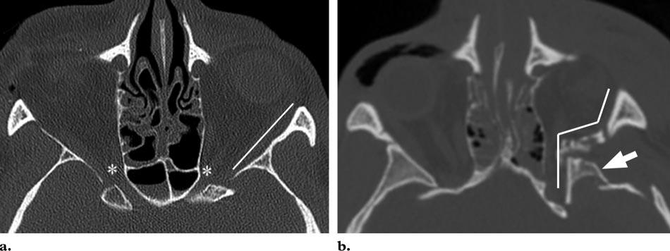 (b) Axial nonenhanced CT image shows that the posteromedial bulge of the left lamina papyracea has collapsed toward the midline.