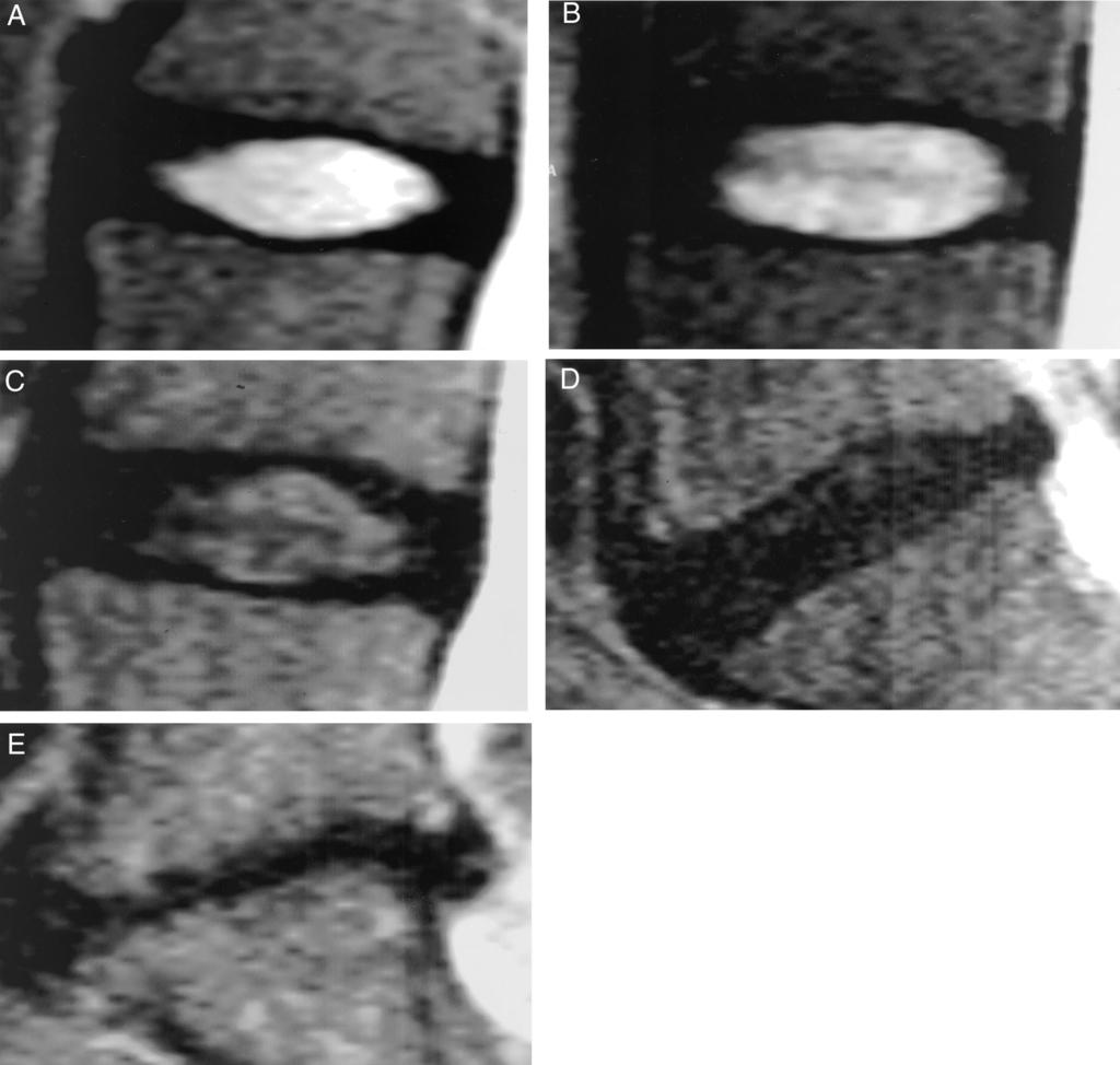MRI Classification of Disc Degeneration Pfirrmann 1875 Figure 1. A E, Grading system for the assessment of lumbar disc degeneration.