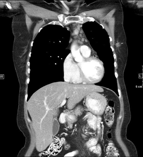 Pt JD: Response on Coronal C+ Chest CT From