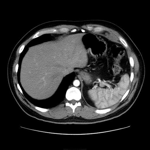 Selected Case: Pt JD, III Left esophageal and