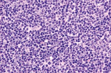 Brief Aside: Follicular Lymphoma Follicular lymphoma is an indolent NHL, with an incidence of ~18,000 cases/year.