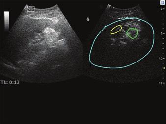 Contrast-Enhanced Ultrasound to Differentiate Renal Tumor Histotypes maximum intensity; and time to peak (TTP; in seconds), defined as the time for the lesion reach maximum intensity.