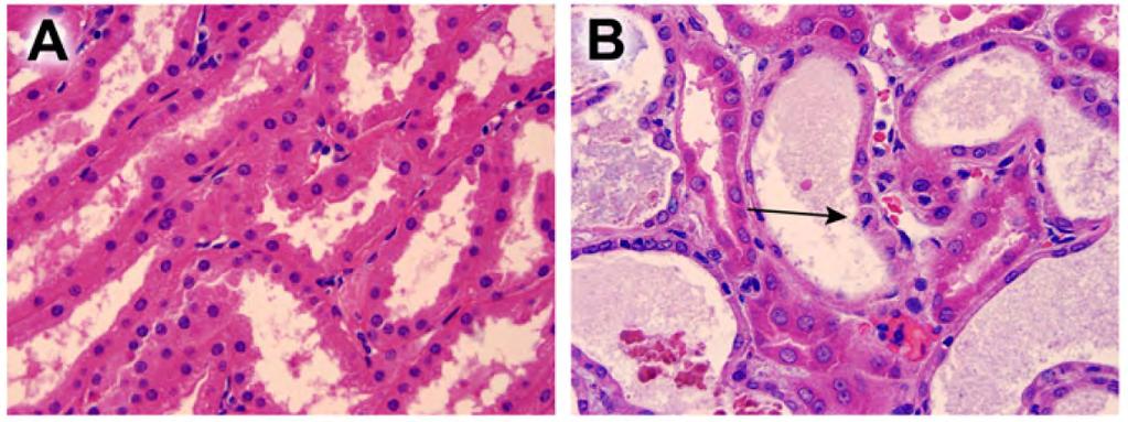 Tubular necrosis and apoptosis Control Sepsis Post- mortem analysis 39 pa1ents (36 with AKI including 14 requiring RRT)