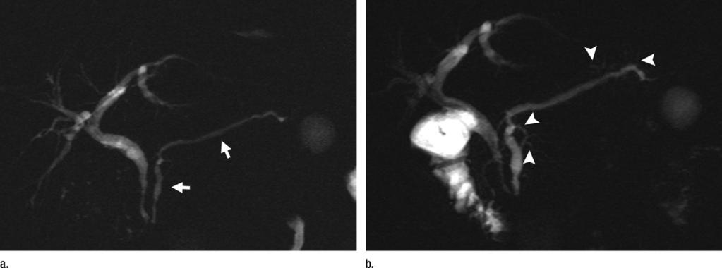 Figure 7 Figure 7: Secretin-enhanced MRCP in mild chronic pancreatitis in 29-year-old woman with recurrent episodes of pancreatic-like abdominal pain.