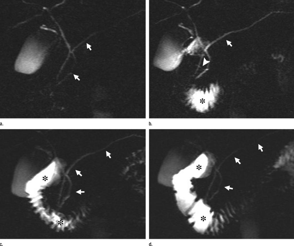 The exogenous administration of secretin during MRCP image acquisition improves pancreatic duct visualization because it is responsible for two simultaneous and concomitant effects on the pancreatic