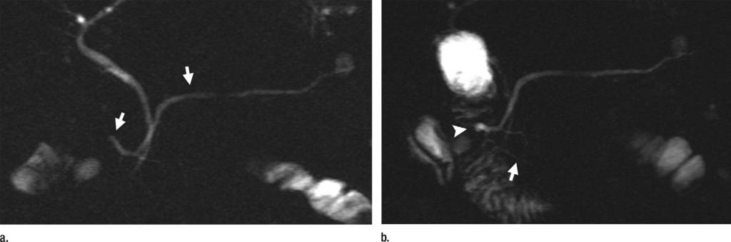 Figure 4 Figure 4: Pancreas divisum with santorinicele. Secretin-enhanced MRCP in 21-year-old woman with recurrent episodes of pancreatic-like abdominal pain.