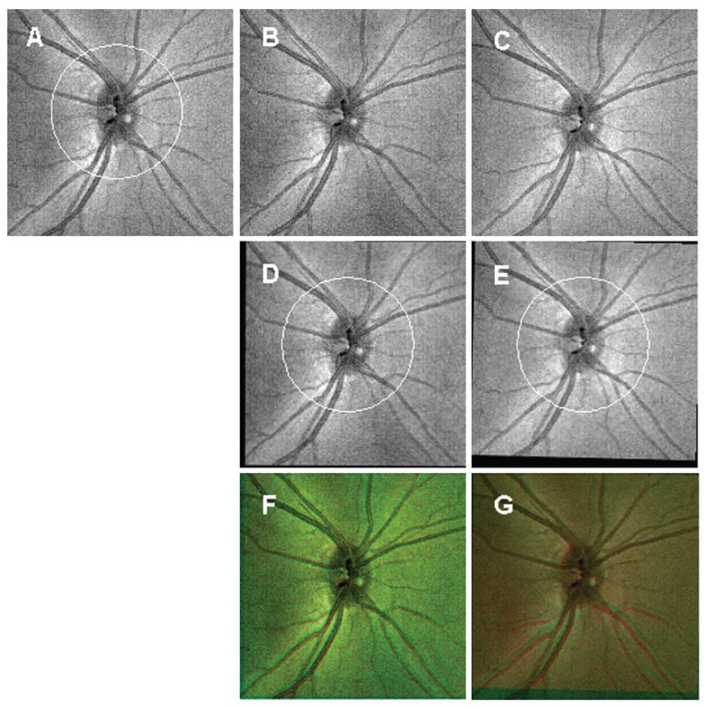 Kim et al. Page 12 Figure 4. Centred Once method importing the automatically detected optic nerve head centre from the reference scan (A) onto the other cube data (B and C) obtained from the same eye.
