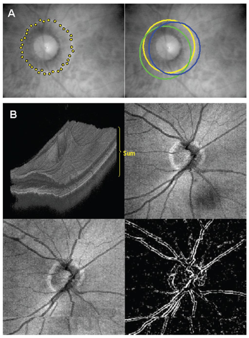 Kim et al. Page 8 Figure 1. (A) Major sources of retinal nerve fibre layer thickness measurement variability using 3.