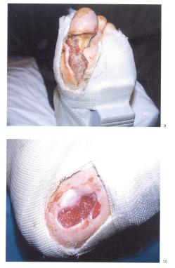 Fiberglass cast in treatment of diabetic foot ulcer the ulcer under study) or leg, amputation of a limb, or plantar bilateral ulcerations.
