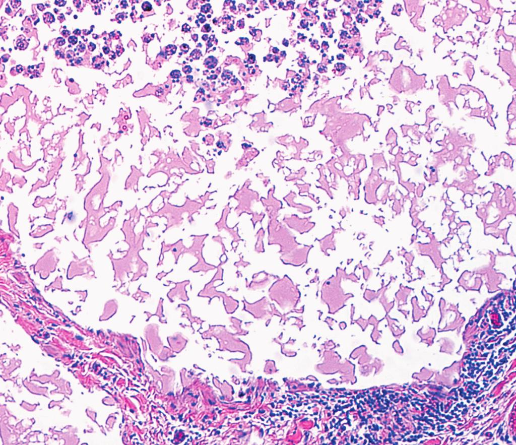 Lawless et al / Lymphangiomatous Lesions of the GI Tract Table 3 Lymphangiectasia: Clinical and Histologic Characteristics Age, y Sex Primary Site Clinical Presentation Endoscopic Appearance 40 F