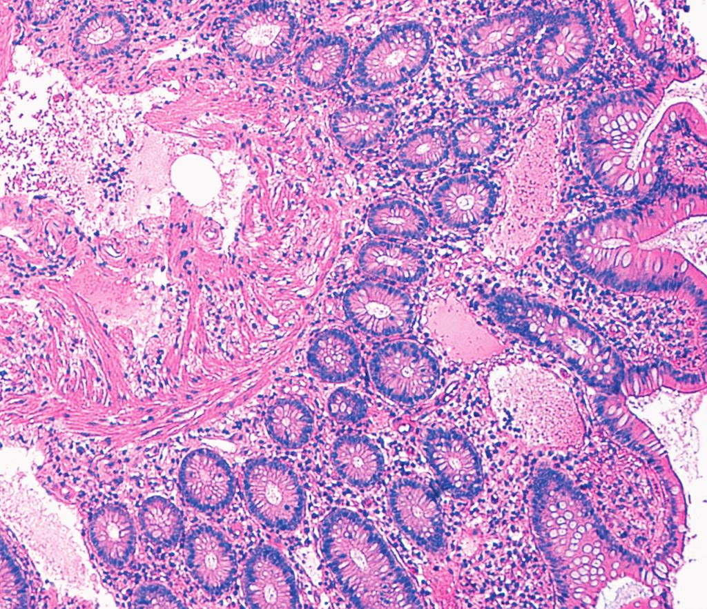 Image 3 Lymphangiectasia: scattered dilated mucosal and submucosal spaces containing intraluminal proteinaceous fluid (H&E, 10). intraluminal proteinaceous fluid. Neutrophilic inflammation was not observed in any of the cases within the series.
