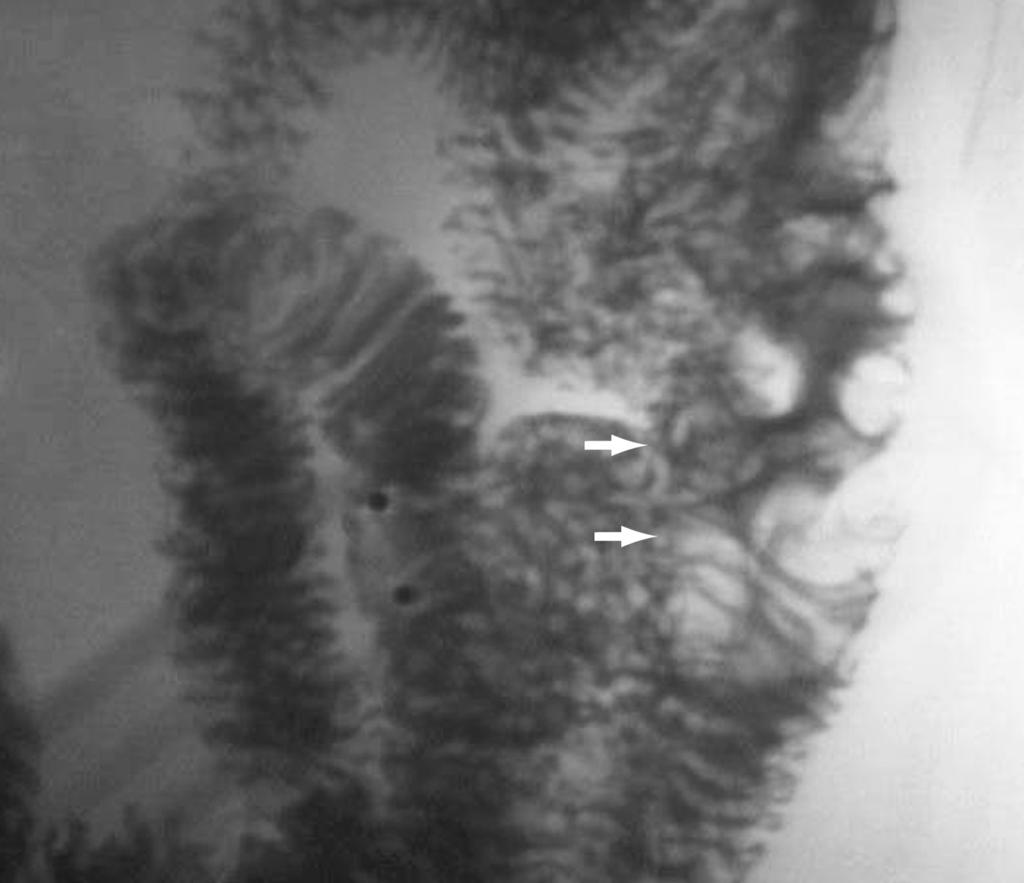 Lawless et al / Lymphangiomatous Lesions of the GI Tract Image 4 Small bowel follow-through study with 5-cm lobular jejunal lymphangioma (arrows). Imaging courtesy of Joel E.