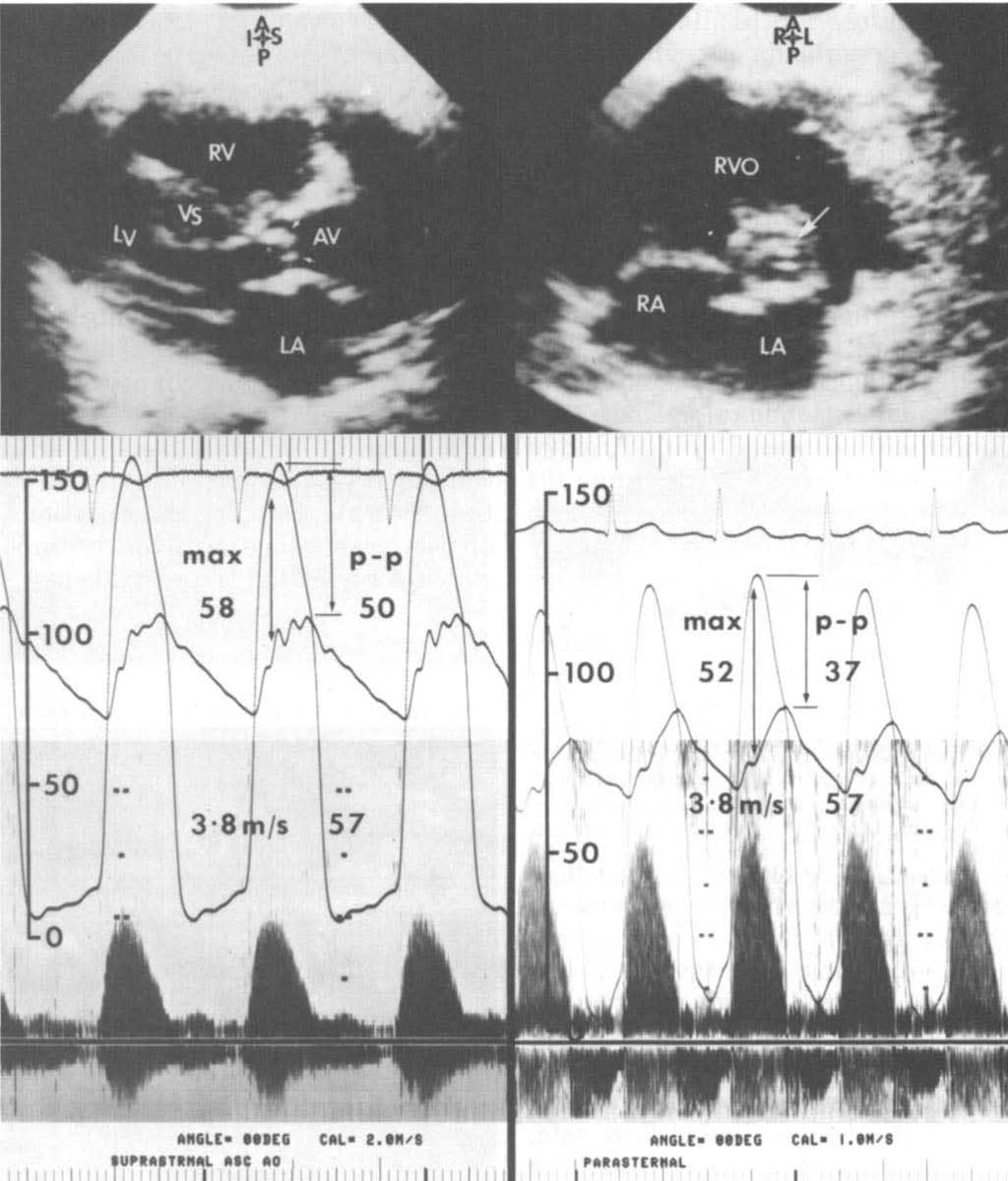 734 DOPPLER IN CONGENITAL HEART DISEASE Mayo Clin Proc, September 1986, Vol 61 Fig. 12. Congenital valvular aortic stenosis.