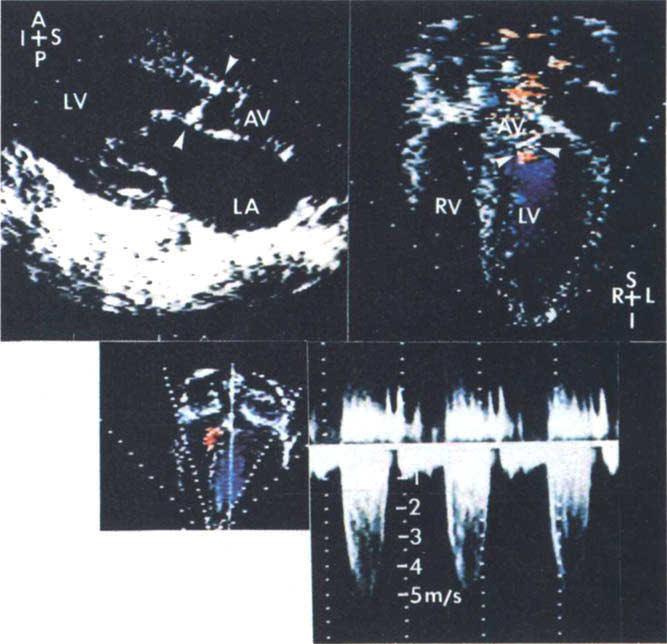 Mayo Clin Proc, September 1986, Vol 61 DOPPLER IN CONGENITAL HEART DISEASE 735 Right Ventricular Outflow Obstruction.