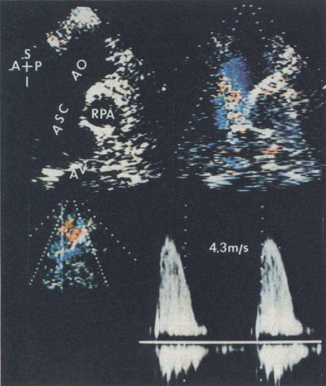 The use of pulsed-wave Doppler for localization of the obstruction 27,28 and continuous-wave Doppler for measurement of the gradient 28 is similar to the approach in obstructive lesions of the left