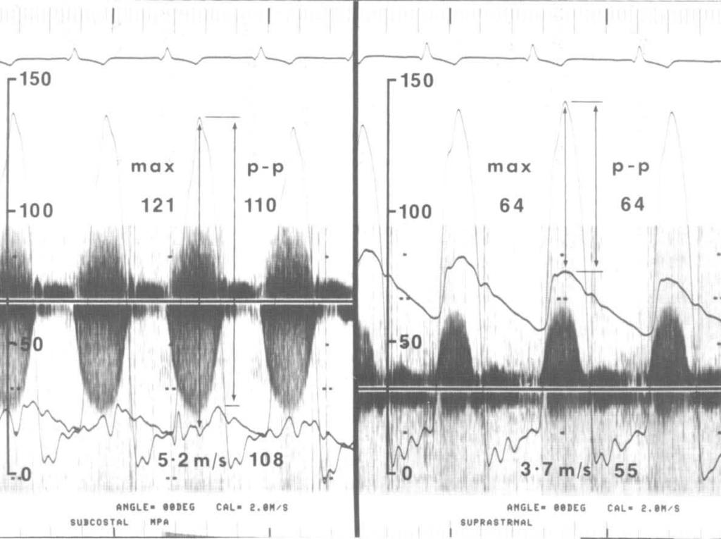 Mayo Clin Proc, September 1986, Vol 61 DOPPLER IN CONGENITAL HEART DISEASE 739 to the immediate vicinity of the prosthesis on pulsed-wave Doppler examination, this finding does not necessarily imply